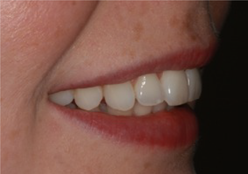 Inman Aligner 3 Inman Aligner 3