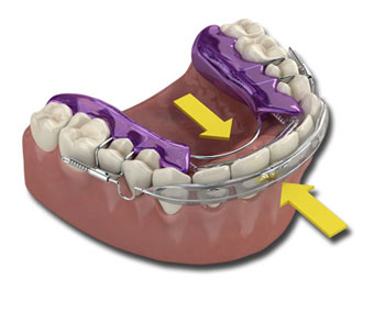 Inman Aligner 1