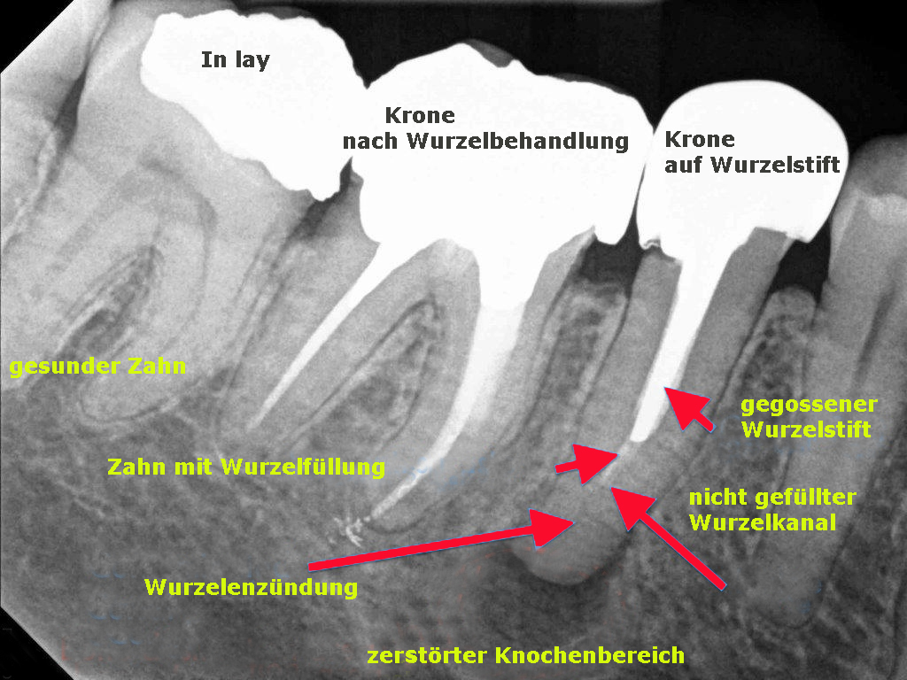 Wurzelbehandlung